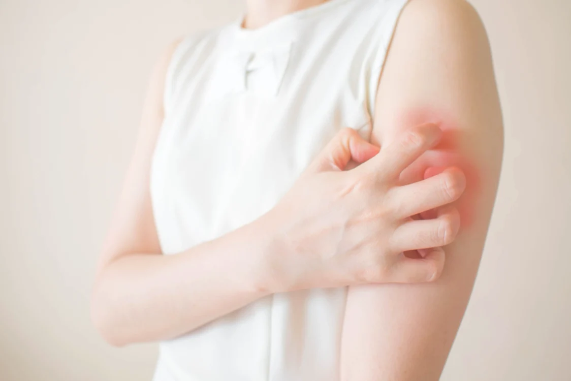 Dermatomiozita este însoţită de erupţii la nivelul pielii