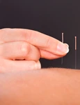 1 efectele benefice ale acupuncturii jpg jpeg