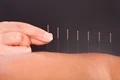 1 efectele benefice ale acupuncturii jpg jpeg