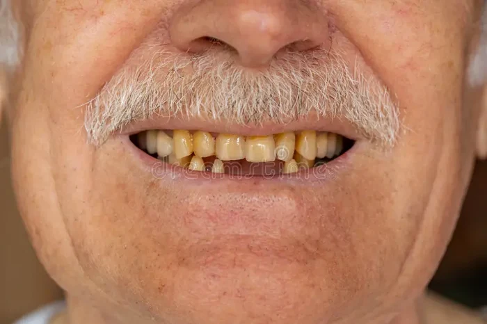 Ce poate semnala pierderea rapidă a dinților la vârstnici. 