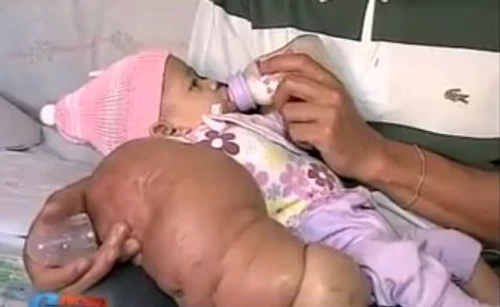 Micuţa Nicole s-a născut cu o mână gigant