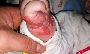 Medicii susțin că este doar o alergie la leucoplast jpeg