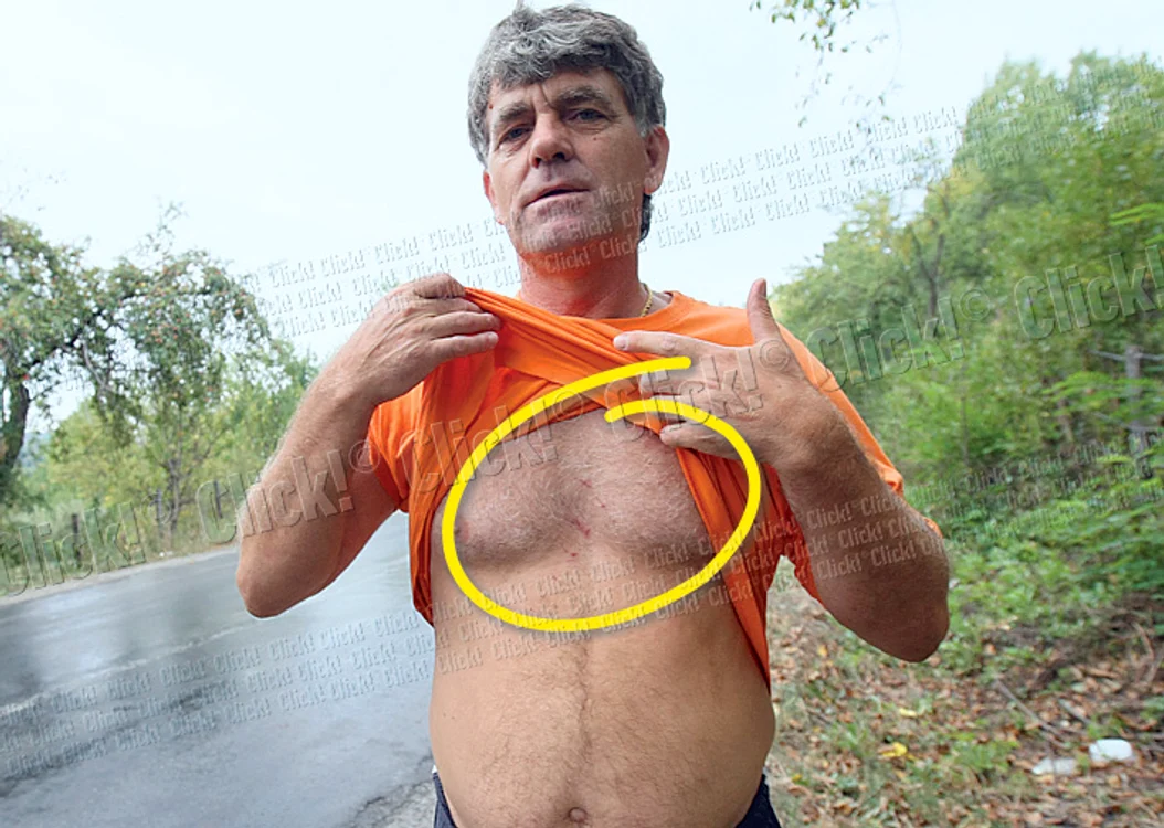 Bărbatul ne-a arătat  urmele lăsate de ghearele ursului pe corpul său (Fotografii: Dorin Constanda)