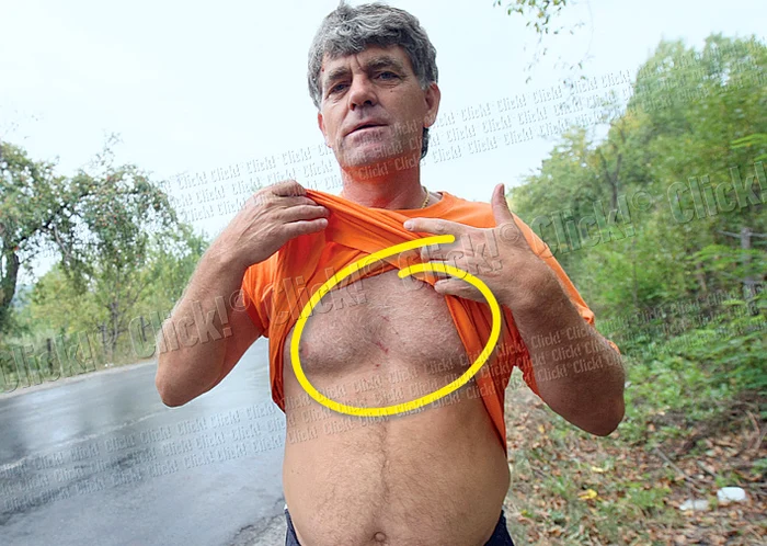 Bărbatul ne-a arătat urmele lăsate de ghearele ursului pe corpul său (Fotografii: Dorin Constanda)