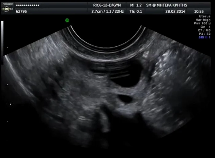 
    Femeia acuza dureri severe în zona abdominală și senzație de balonare constantăFoto: Captură video  