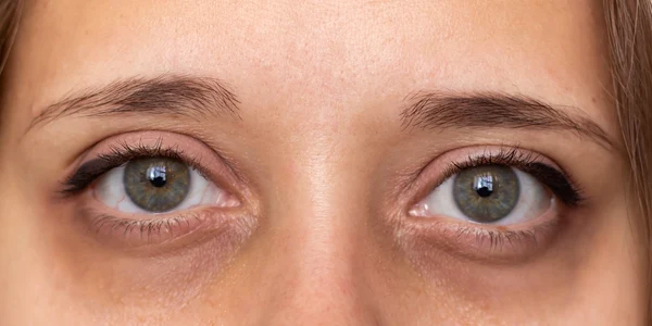 Cearcănele pot semnala o problemă de sănătate gravă, avertizează nutriționiștii Foto Anderson Eye Care