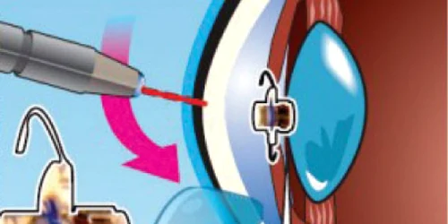 Tratamentele cu laser care le pot reda vederea perfectă pacienţilor 