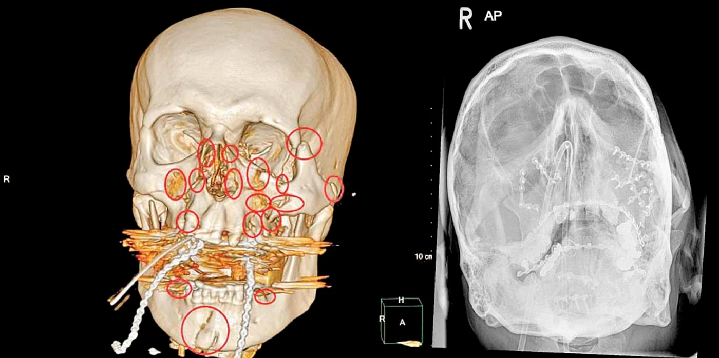 În radiografii  se vede cum  i-a fost  reconstruit  craniul