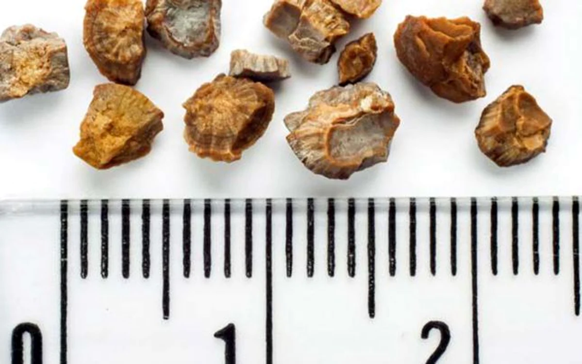 5 ceaiuri contra pietrelor la fiere