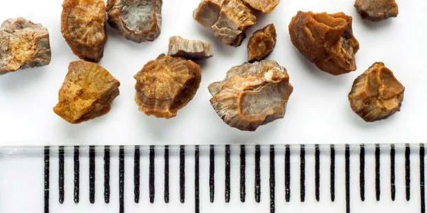 5 ceaiuri contra pietrelor la fiere