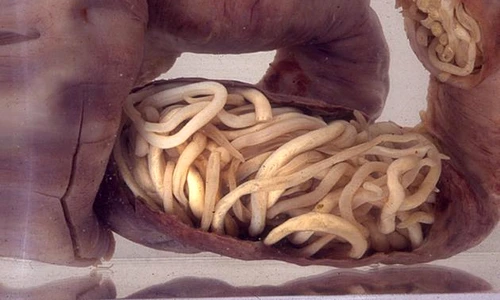 1 ai aceste simptome intestinele tale ar putea fi pline de paraziti uite ce sa faci ca sa scapi de ei kzjb jpg jpeg