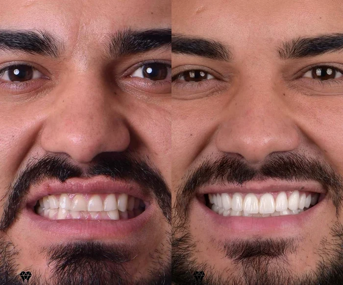 Jador, înainte și după ce și-a pus fațete / foto: Instagram