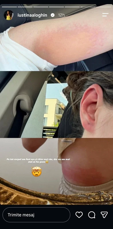 Problema cu care se confruntă Iustina Loghin. Foto: Instagram