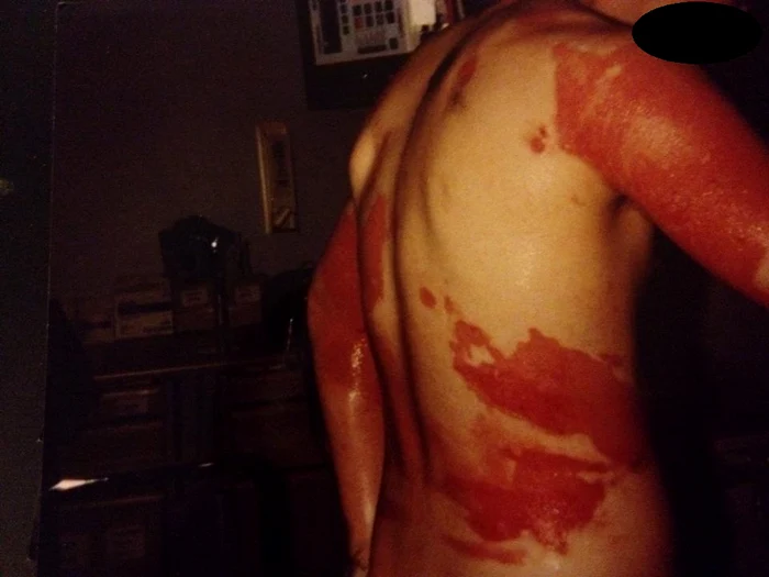 Arrsurile suferite de bărbat l-au ținut zile bune în spital