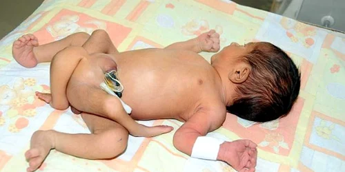 Bebelușul, înainte de operație