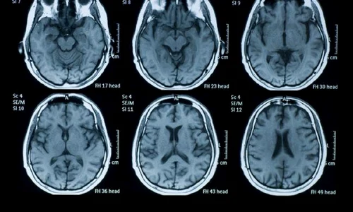 studiu marijuana poate afecta memoria si ar putea chiar avea legatura cu schizofrenia 239954 jpg