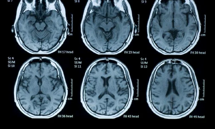 studiu marijuana poate afecta memoria si ar putea chiar avea legatura cu schizofrenia 239954 jpg