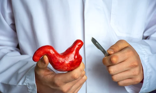 1 micsorare stomac jpg jpeg