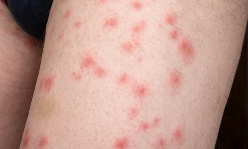 muscatura plosnite pat jpg