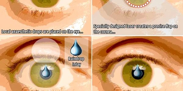 implant ocular
