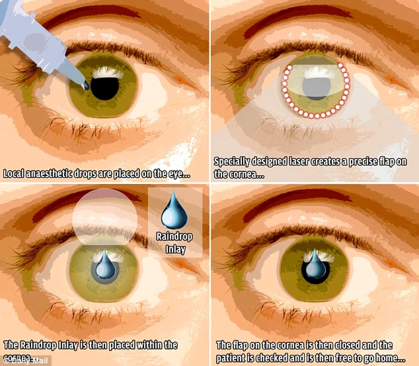implant ocular