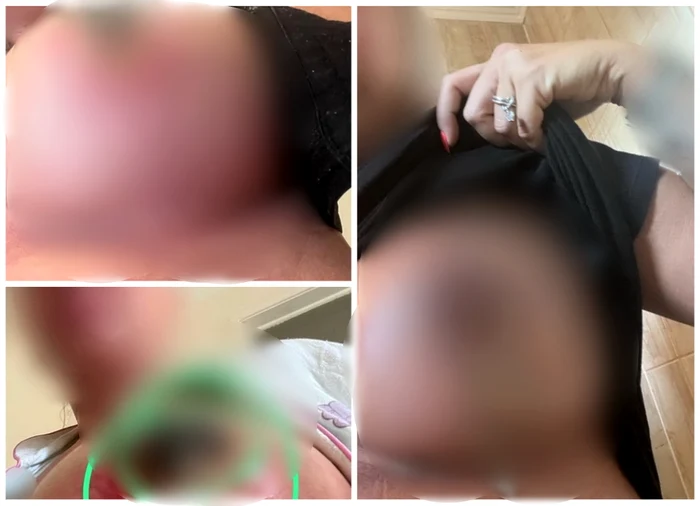 O orădeancă a ajuns la Urgenţă după o operaţie estetică realizată în Turcia. Foto: arhiva personală