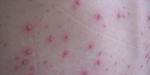 Varicela FOTO Spitalul de Boli Infectioase Timisoara