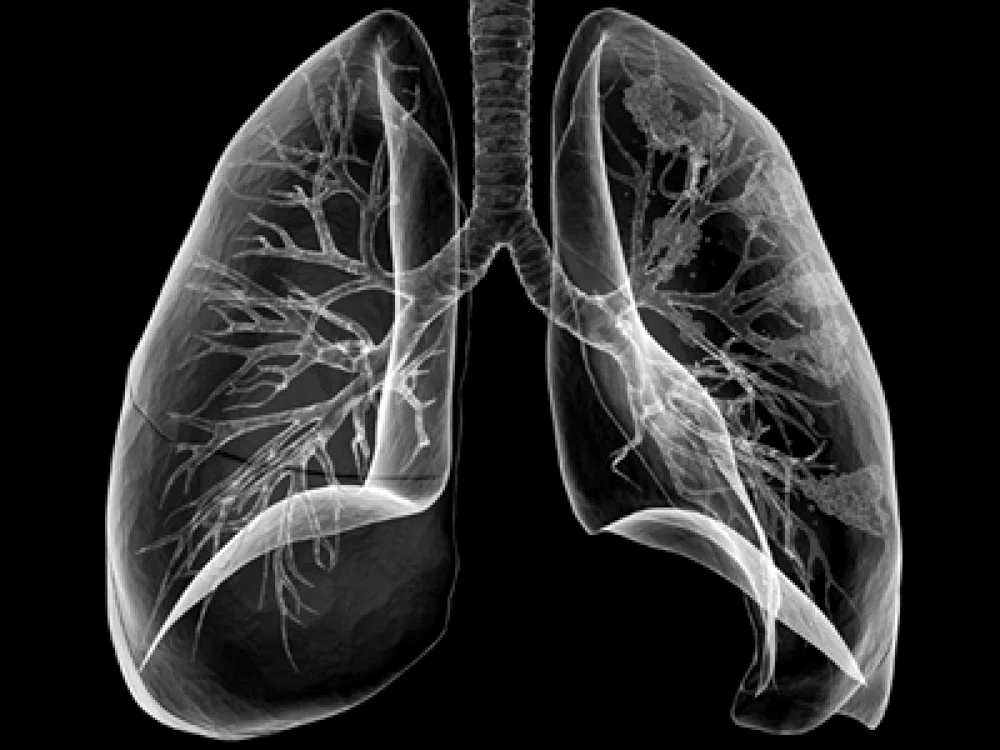 Sănătatea plămânilor este foarte importantă susţin medicii