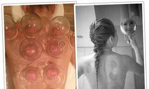 Îşi pune ventuze  pentru a şi  dezintoxica  organismul jpeg