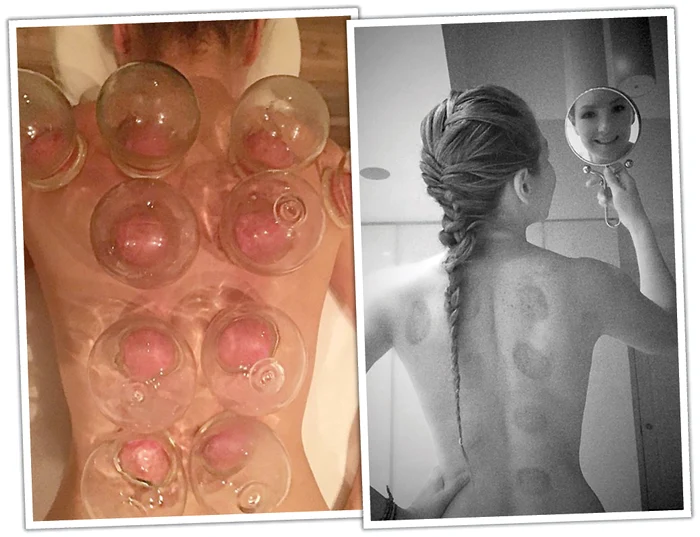 Îşi pune ventuze pentru a-şi dezintoxica organismul