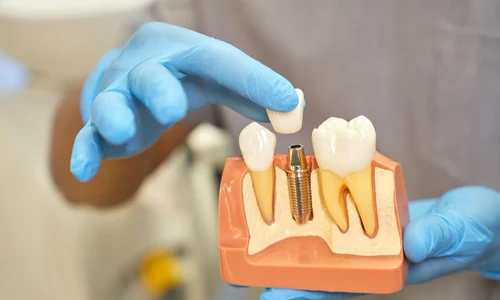 implant dentar jpeg