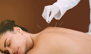 acupunctura(1) jpg