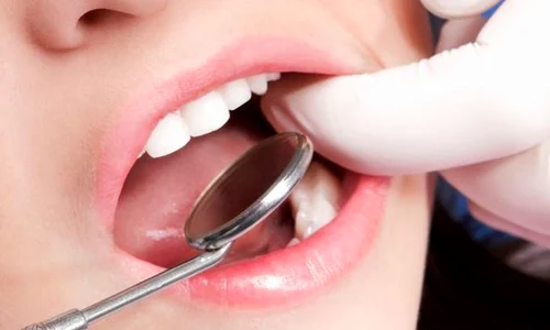 1 sangerarile gingivale jpg jpeg