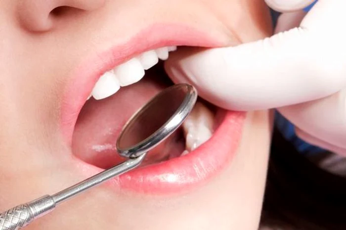 1 sangerarile gingivale jpg jpeg