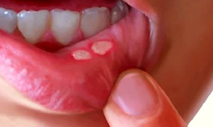 1 ulcer bucal si afte remediile astea naturiste te scapa imediat de problema bf8h jpg jpeg