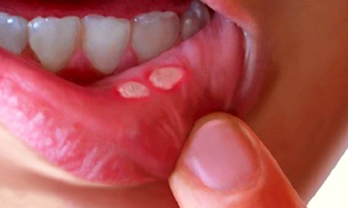 1 ulcer bucal si afte remediile astea naturiste te scapa imediat de problema bf8h jpg jpeg