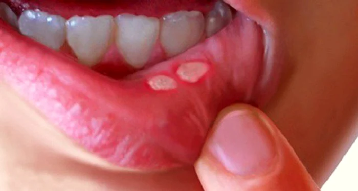 1 ulcer bucal si afte remediile astea naturiste te scapa imediat de problema bf8h jpg jpeg