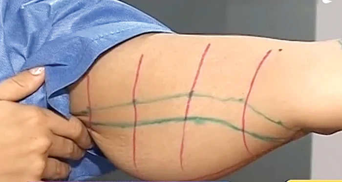 Înainte de operaţie, Oanei  i s-au marcat pe braţele  cu pielea lăsată zonele  unde se vor face inciziile