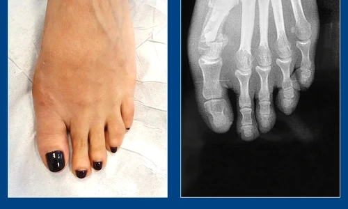 1 caz 1 monturi jpg jpeg