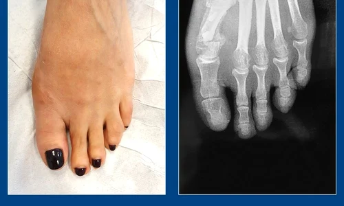 1 caz 1 monturi jpg jpeg