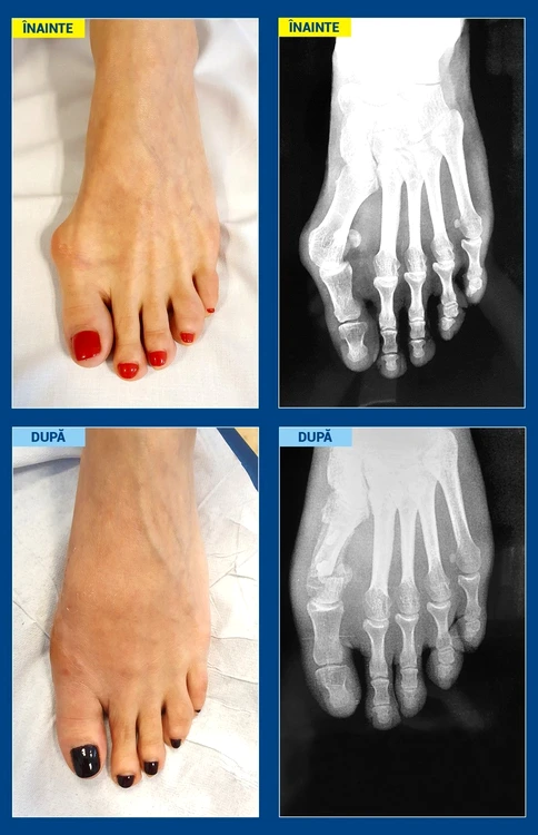 1 caz 1 monturi jpg jpeg