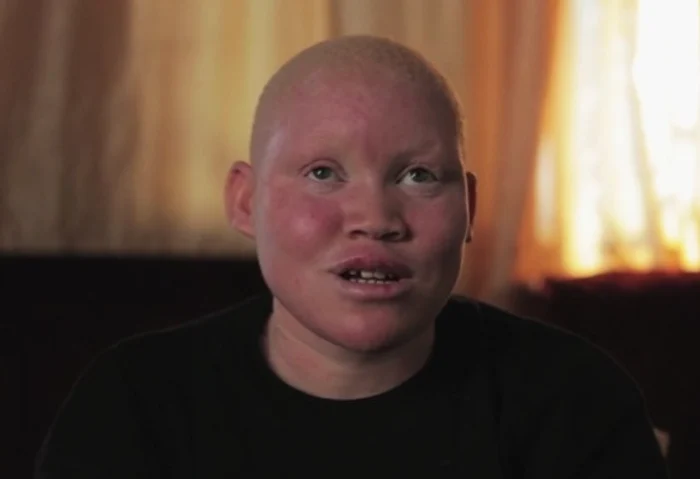 
    Vracii sunt dispuşi să plătească 75.000 de dolari pentru un set complet de membre ale unei persoane cu albinismcaptură: YouTube  