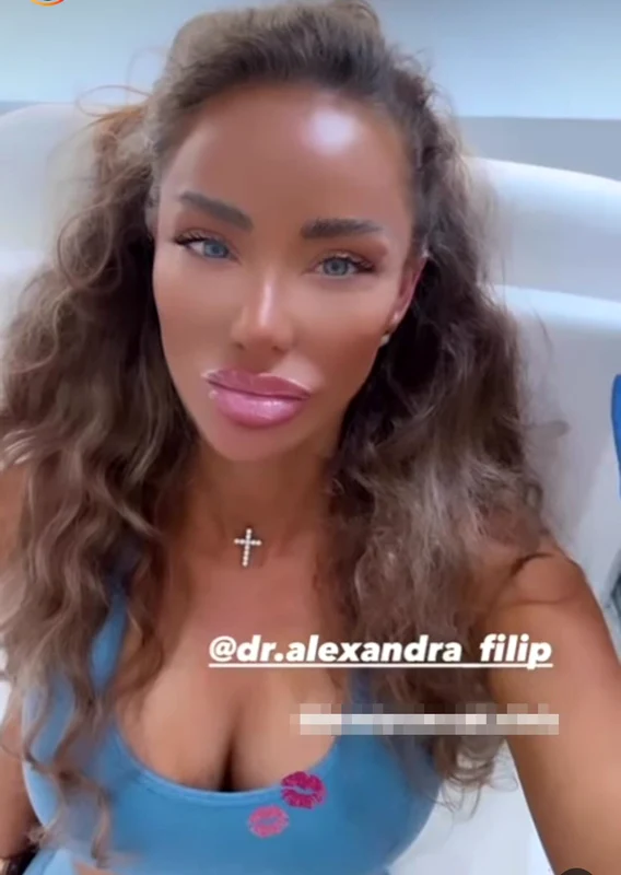Bianca Drăgușanu, o nouă intervenție estetică. Sursă: Instagram