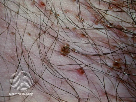 pubic lice  WatermarkedWyJXYXRlcm1hcmtlZCJd jpg