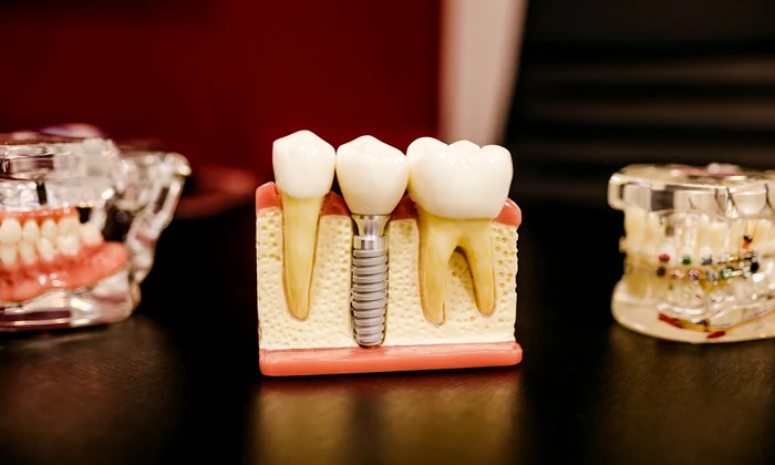 1 implant jpg jpeg