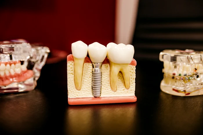 1 implant jpg jpeg