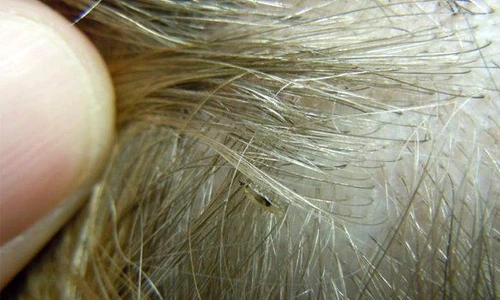 1 tratament pentru paduchi jpg jpeg