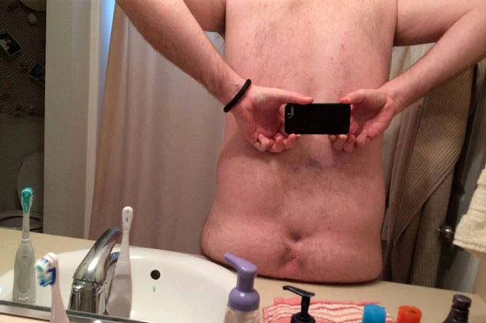 A rămas fără fese în urmei unei operaţii