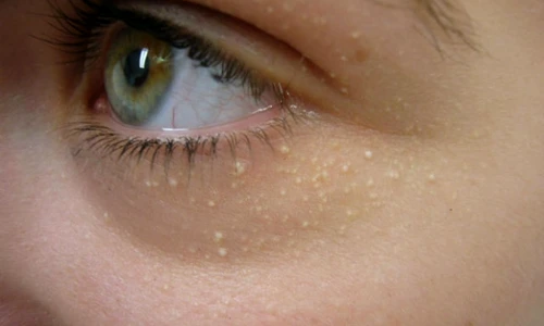 puncte de grăsime în jurul ochilor jpeg