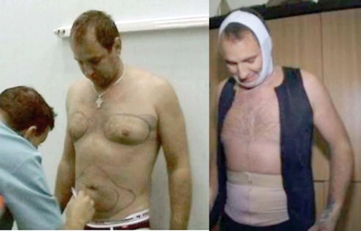 
    2010. Actorul se mândrea, după  operaţie, cu  abdomenul plat  